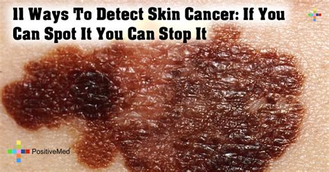 11 Ways To Detect Skin Cancer If You Can Spot It You Can Stop It