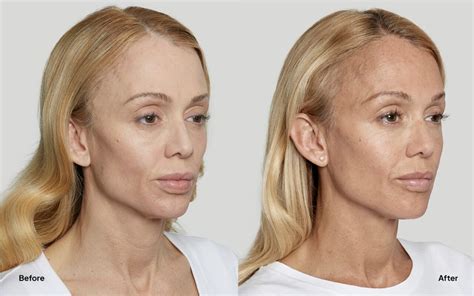 sculptra® in fresno facial restoration mystique medical spa
