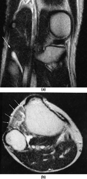 Non Traumatic Peroneal Nerve Palsy Mri Findings Clinical Radiology