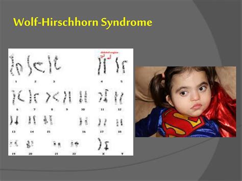 Wolf Hirschhorn Syndrome Adult