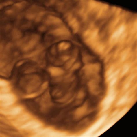 6 Weeks And 5 Days Pregnant Baby Fetal Progress Ultrasound