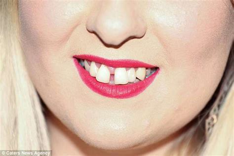 Woman 29 Reveals How She Developed Rotting Teeth After Getting