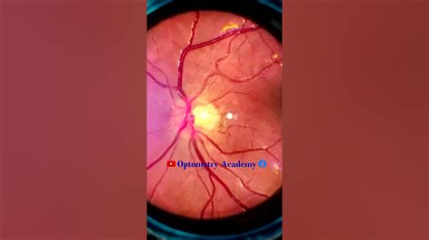 Smartphone Fundus Videography Fundus Photography Normal Fundus