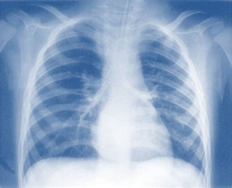 Download the perfect xray pictures. Xray | Free Images at Clker.com - vector clip art online, royalty free & public domain