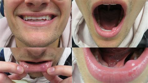 Lower Lip Bump Mucocele Verus Mucus Retention Cyst Minor Salivary