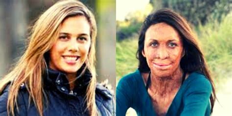 Turia Pitt Before And After Photos