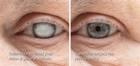 How Long To Recover From Cataract Surgery