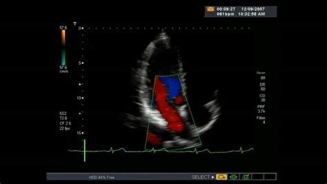 Echocardiogram Heart Ultrasound Youtube