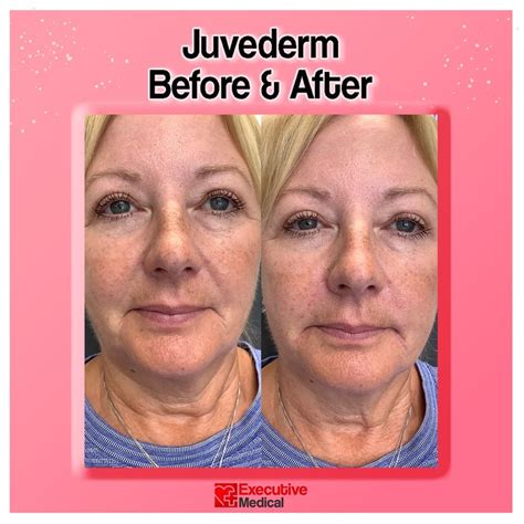 Juvederm Before And After San Diego Remove Wrinkles Dermal Fillers