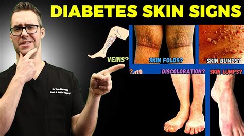 TOP Diabetes Skin Signs Symptoms Type Diabetes Mellitus YouTube
