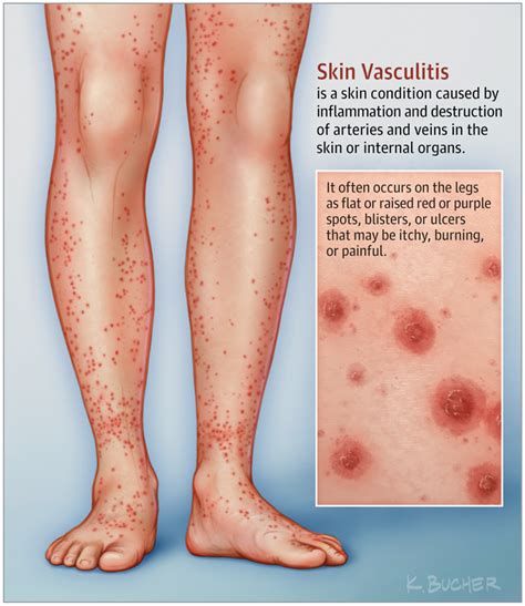 This Patient Page Describes Vasculitis Focusing Especially On Skin
