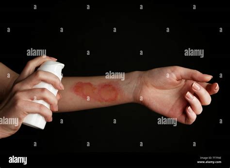 Treatment Of Burns By Spray On Female Hand On Black Background Stock