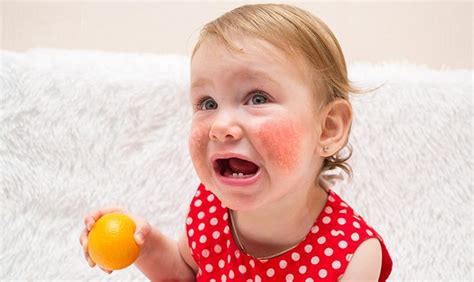 Food Allergies In Babies Causes Symptoms And Treatment Loving Parents