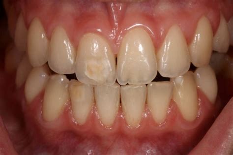 Disgusting Brown Spots On Teeth And A List Of 6 Causes