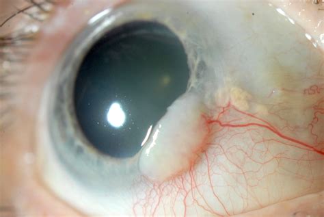 Pathology Outlines Conjunctiva Conjunctival Intraepithelial Neoplasia