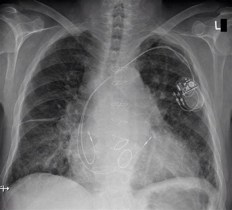 Radiology Signs • Prosthetic Heart Valves On Chest X Ray How Can