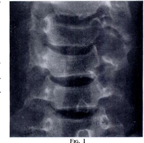 Figure 1 From Giant Cell Tumours And Aneurysmal Bone Cysts Of The Spine