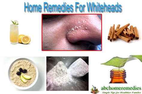 15 Ideal Home Remedies For Whiteheads Whiteheads Whiteheads Remedy