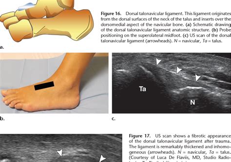 Dynamic High Resolution Us Of Ankle And Midfoot Ligaments Normal