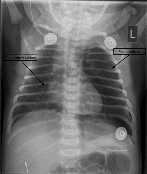Infant Pneumothorax X Ray