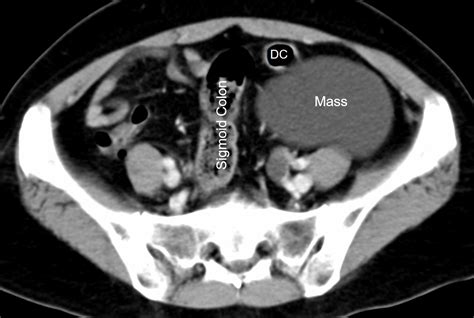 Mesenteric Cyst Radiology Cases