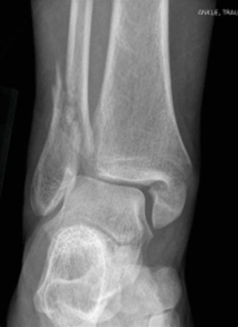 Anklepilon Fractures Musculoskeletal Key