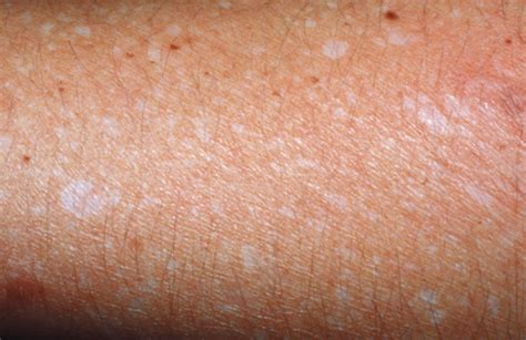 Por qué aparecen manchas blancas en la piel y como prevenirlas