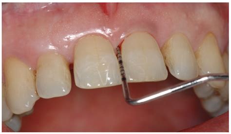 Jcm Free Full Text Predictive Periodontitis The Most Promising