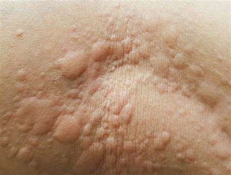 Here are other symptoms to watch for, how to find relief, and when to see a doctor. What are hives, the common skin condition that gives you ...