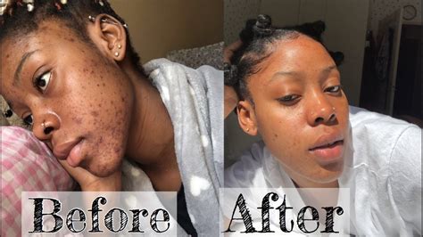 How I Got Rid Of My Hyperpigmentation Acne Andacne Scars Within A Month