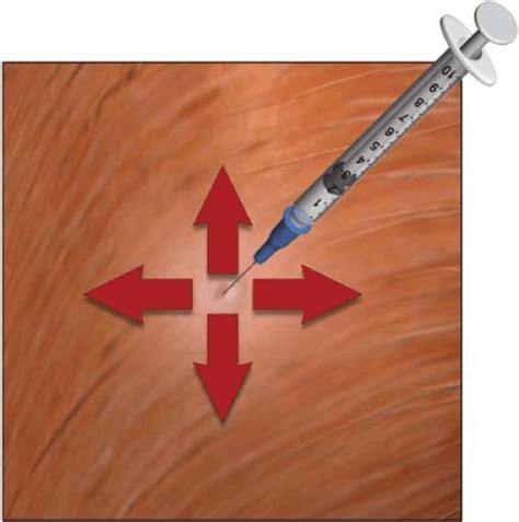 Trigger Point Injections For Myofascial Pain Anesthesia Key