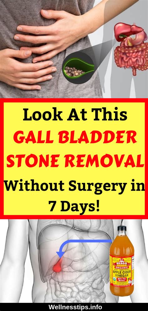 See Gall Bladder Stone Removal Without Surgery In 7 Days Gallbladder