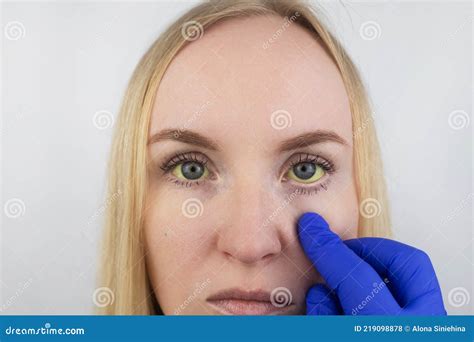 The Yellow Color Of The Woman Eye Symptom Of Jaundice Hepatitis Or