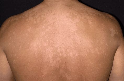Medical Skin Care Tinea Versicolor Skin Fungus