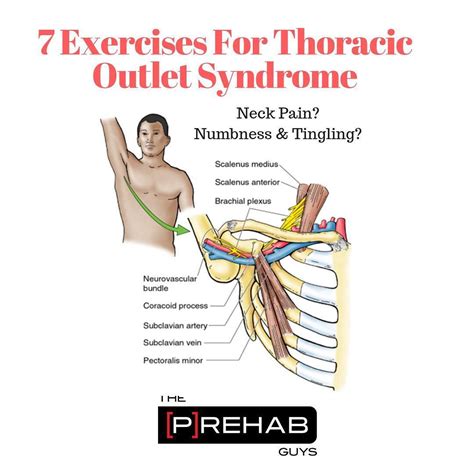 Thoracic Outlet Syndrome Pictures