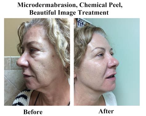 Microdermabrasion Chemical Peel Beautiful Image Treatment Before And