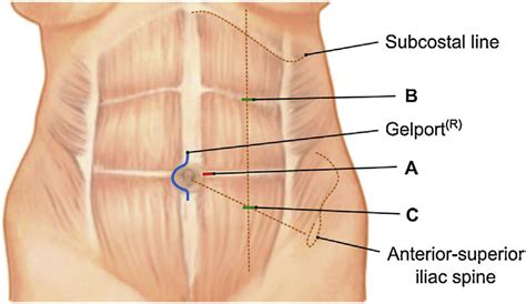 Trocar Placement The Hand Assistance Device Gelport Was Placed Download Scientific