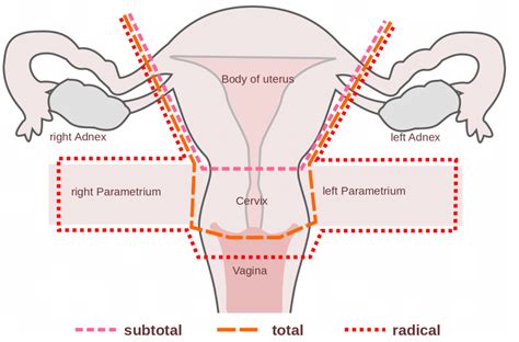 Hysterectomy Procedure Indications Complications Teachmeobgyn