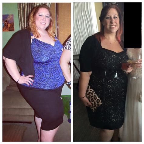 15 Captivating Weight Loss Surgery Before And After Sleeve Best