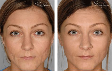 Restylane Before After Full Face 09 Skin Care Center Of Southern Illinois