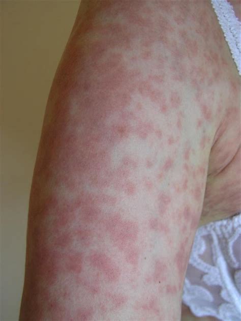 Viral Infections Epstein Barr Infection Picture Hellenic