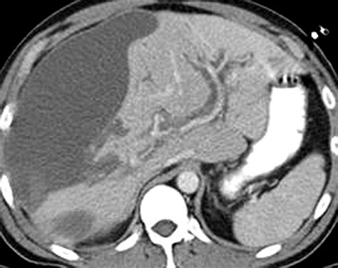 Blood In The Belly Ct Findings Of Hemoperitoneum Radiographics