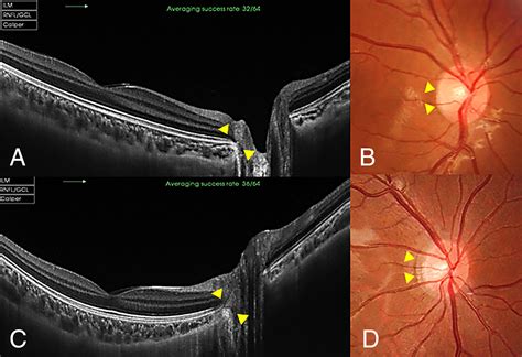 Posterior Segment Conditions Associated With Myopia And High Myopia