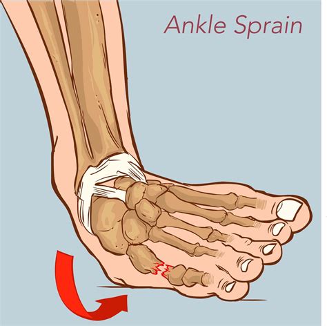Illustration Showing A Sprained Ankle Ankle Sprain Symptoms Sprained