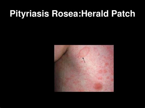 Herald Patch Pityriasis Rosea Causes Longislandmaxb