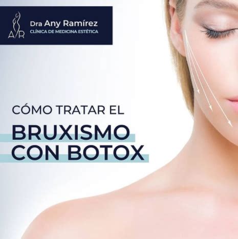 Cómo tratar el bruxismo con botox Doctora Any Ramírez medicina estética