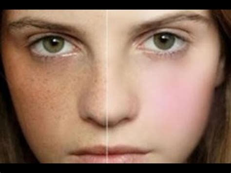 How To Get Rid Of Freckles All You Need Infos