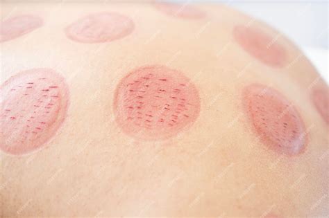 Premium Photo Wet Cupping Marks And Cuts On Patient After Hijama