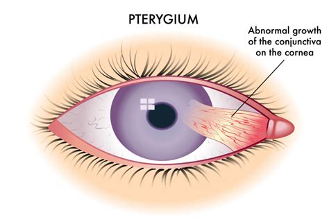 Common Eyelid Disorders