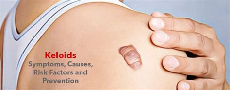 Keloids Symptoms Causes Risk Factors And Prevention